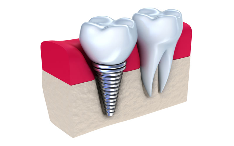 ایمپلنت در کرج